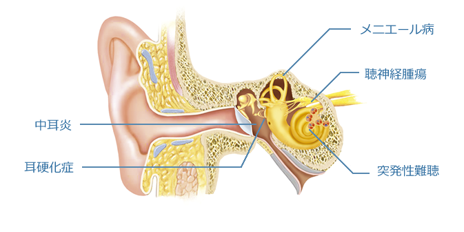 難聴に関する主な耳の病気